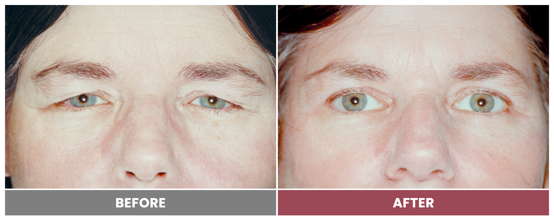 Upper Blepharoplasty - Case 109